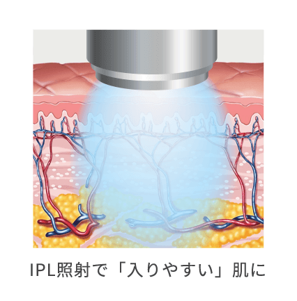 IPL照射で「入りやすい」肌に